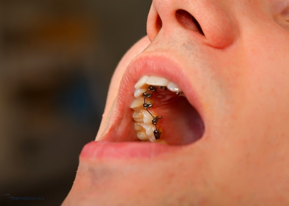 person opening their mout showing lingual braces, one of the alternatives to braces in little falls, NJ