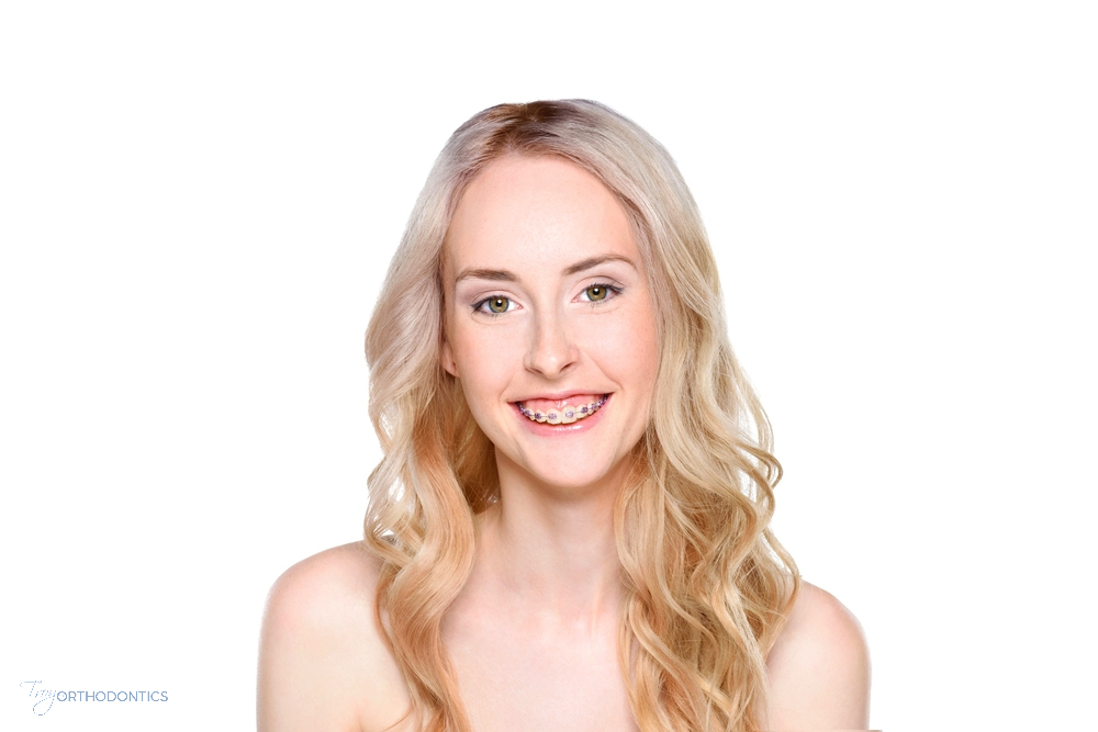 Smiling blonde woman showing straight teeth—confident results after discovering how to fix overbite in Little Falls, NJ.
