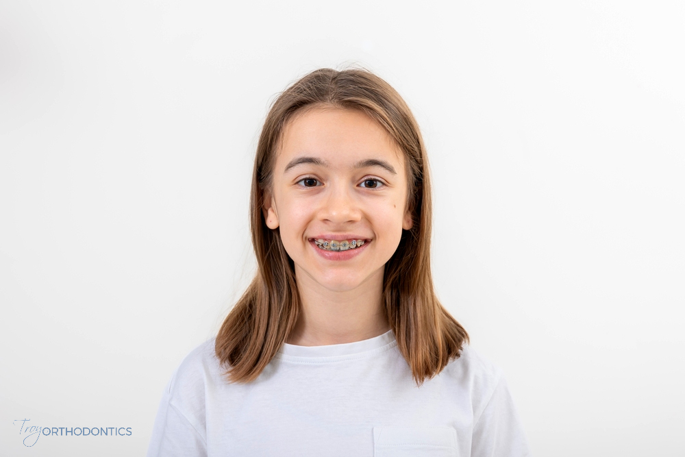 Smiling teenage girl with braces, showcasing progress in orthodontic braces for overbite in little falls and metuchen, nj.